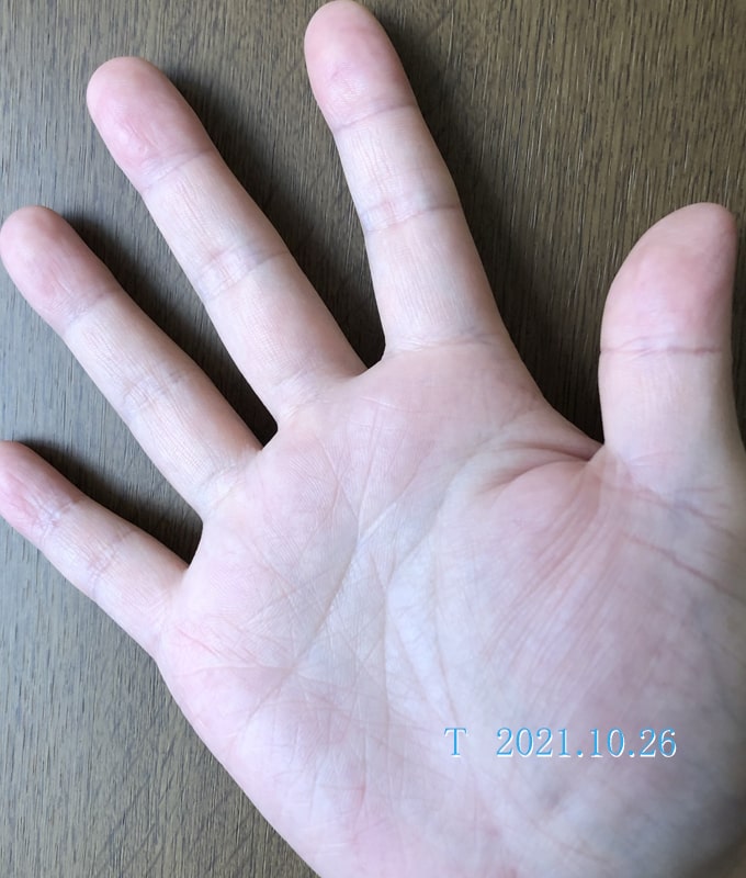 手湿疹を乗り越えよう ばっちり治った手湿疹